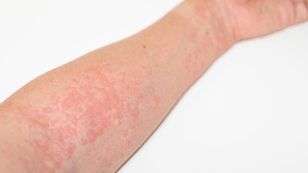 hives treatment online