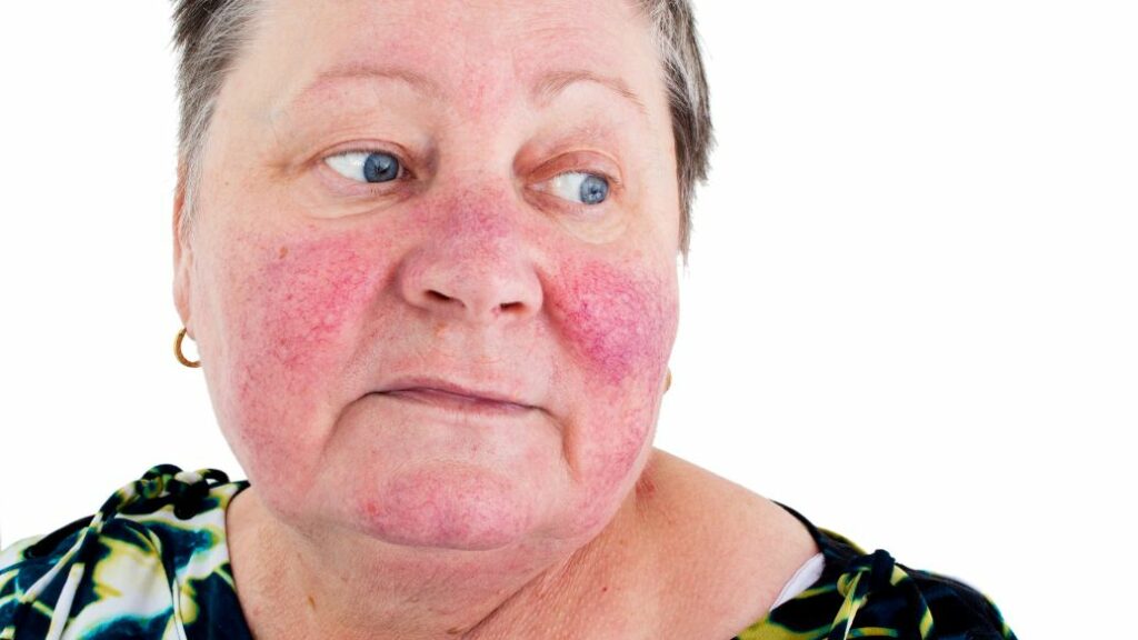 rosacea treatment