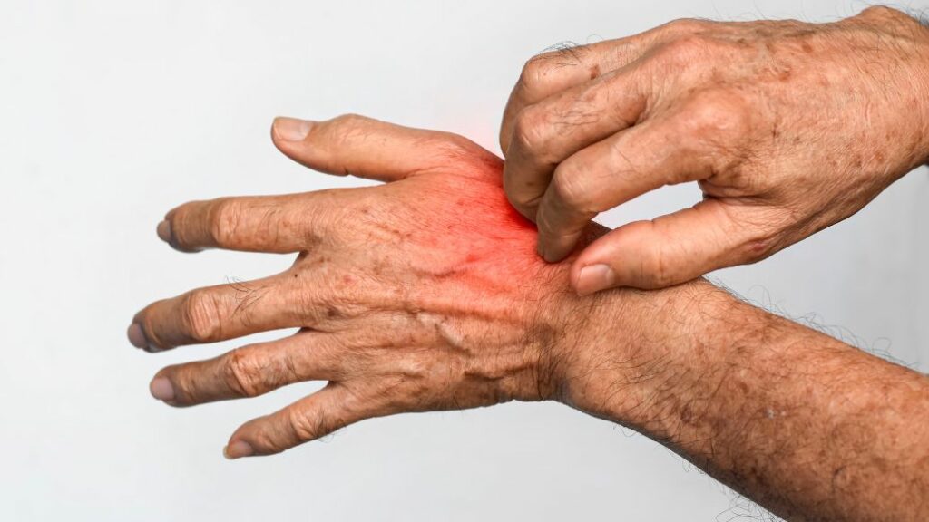 scabies treatment