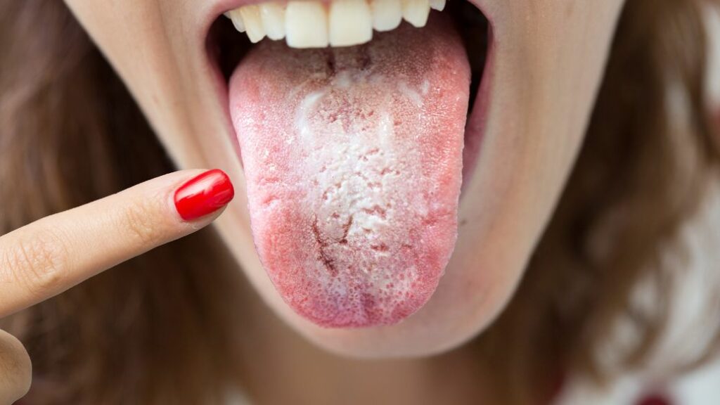 Get Oral Thrush Treatment Online